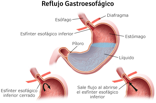 reflujo gastroesofagico